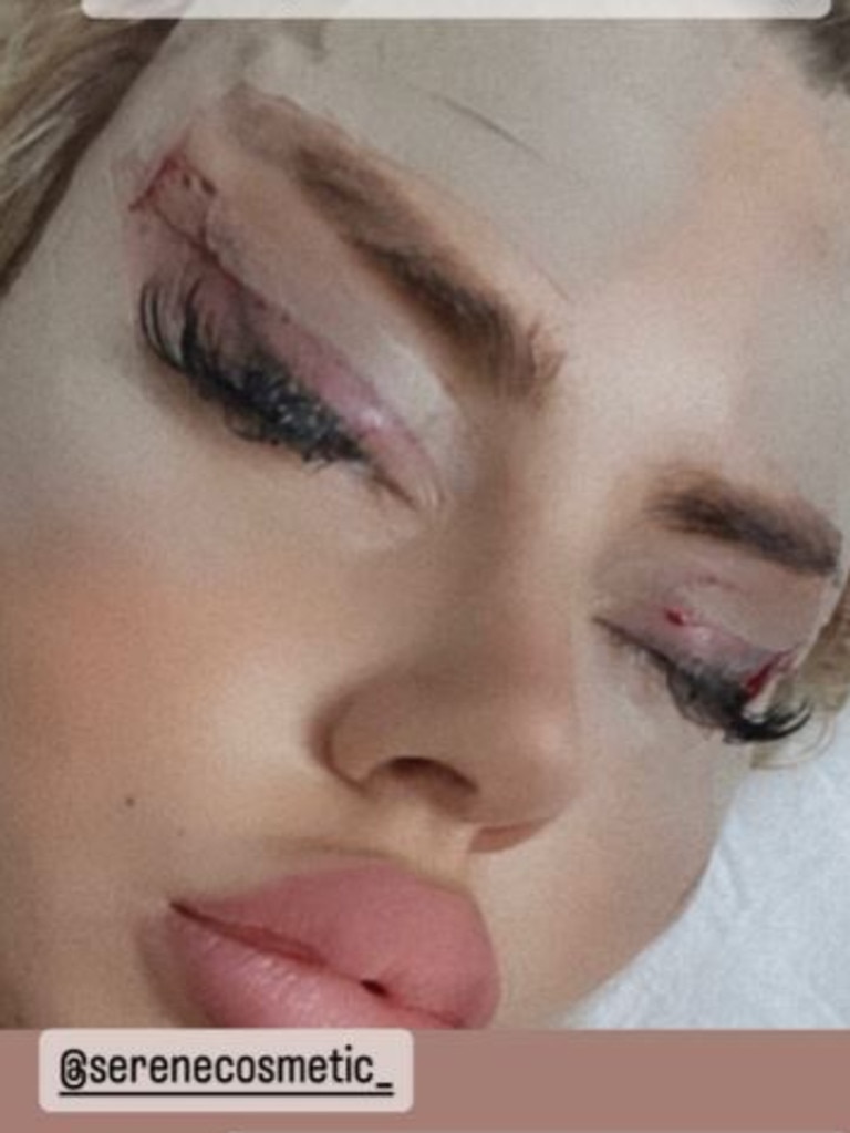 Love Island’s Hannah Elizabeth shows off surgery that makes her look like ‘Bratz Doll’ The