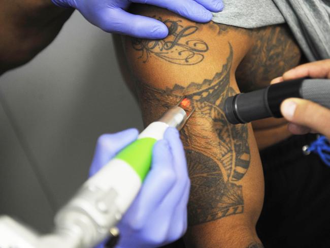 Tattoo removal can be expensive and painful.