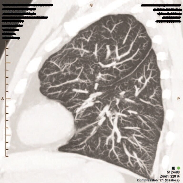 A scan of former Central Queensland miner Craig Keogh's lungs.