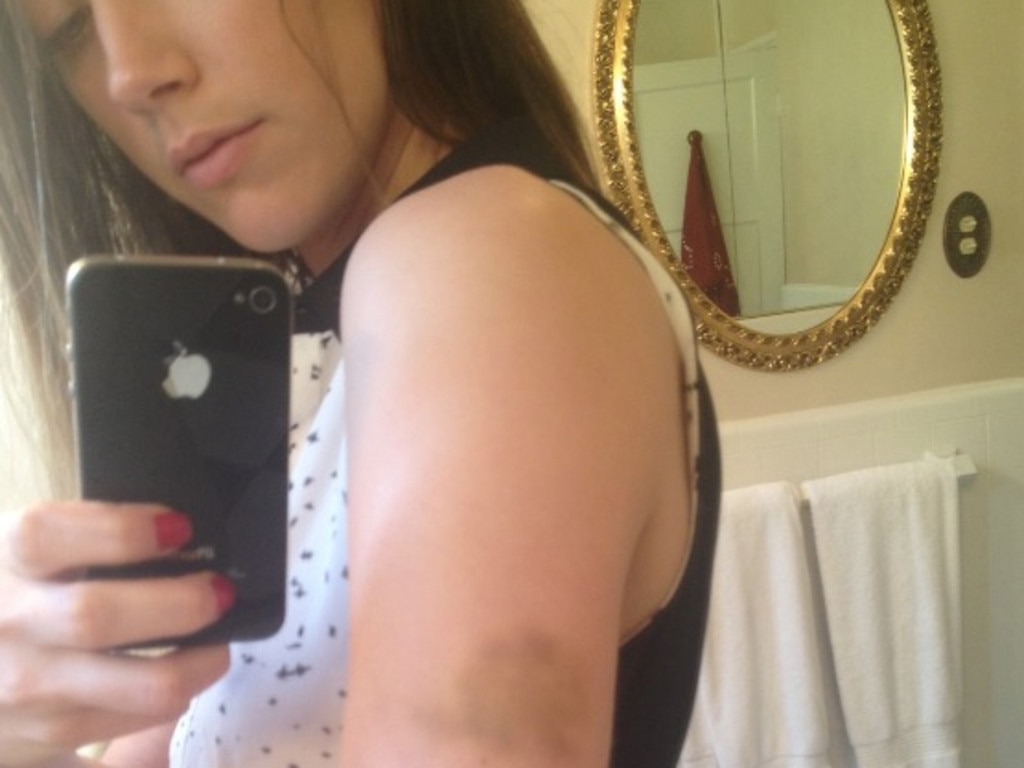 This photo shows Heard with what is claimed to be a bruise on her arm after an alleged incident in March 2013.