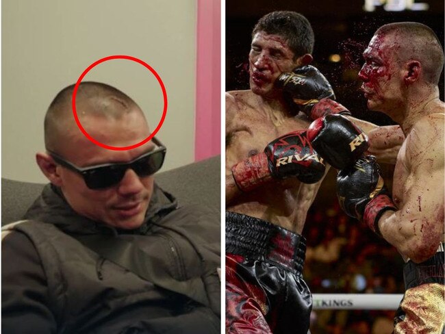 Tim Tszyu's fresh scar after his shock loss. Photos: Fox Sports/No Limit Boxing