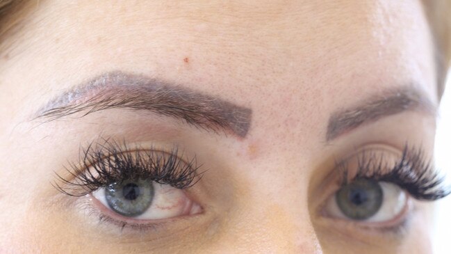 An example of poorly tattooed eyebrows provided by the Aesthetics Practitioners Advisory Network.