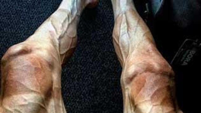 You’re so vein: Tour de France rider and legs