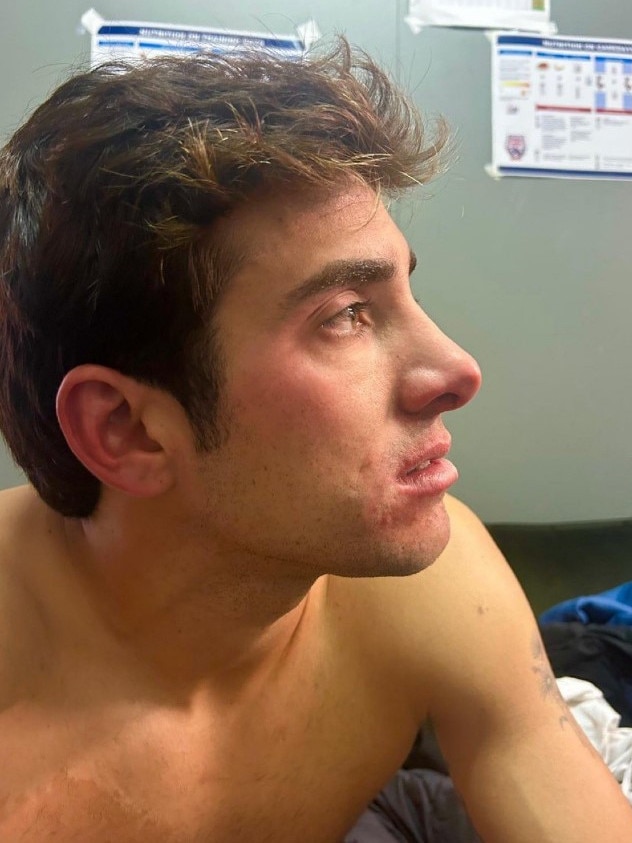 Garin's eye was red and swollen. Photo: Instagram.