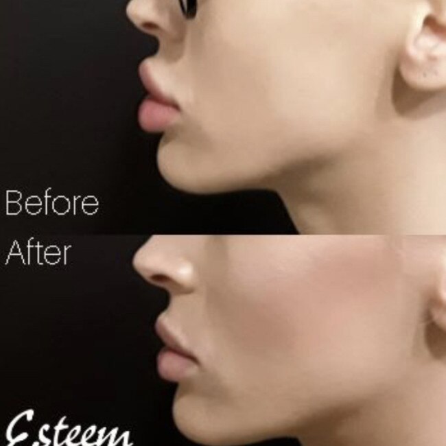 A lip filler correction provided by Esteem Clinic