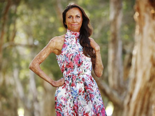 WEEKEND TELEGRAPGH - 11/6/21Turia Pitt pictured at Centennial Park today. It has been a decade since the horrible disaster that changed her life forever. Picture: Sam Ruttyn