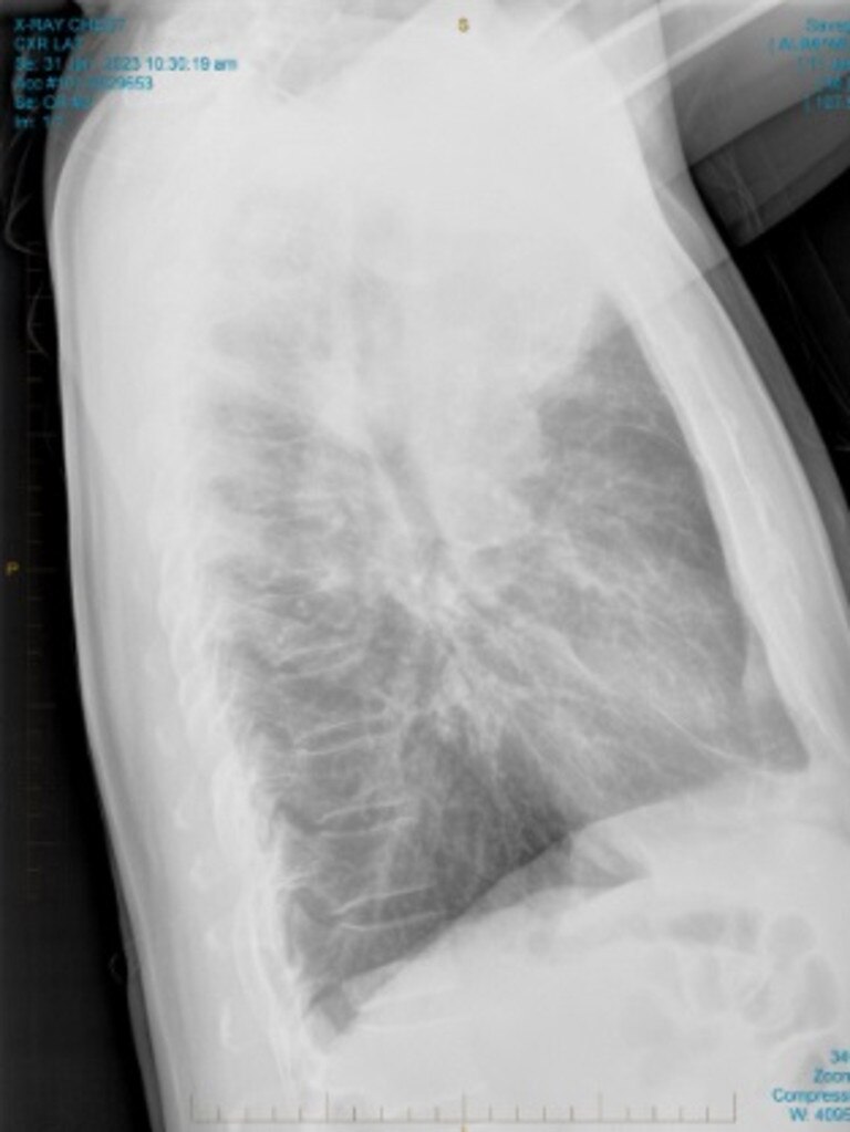 He was told he has extensive small cell lung cancer, an aggressive form of lung cancer. Picture: Supplied