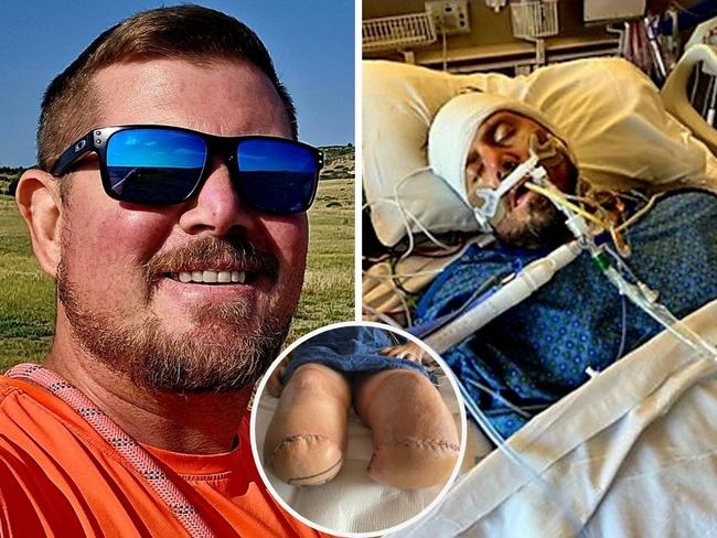 Max Armstrong, 40, contracted sepsis after burning his thumb on a camping trip. Picture: SWNS