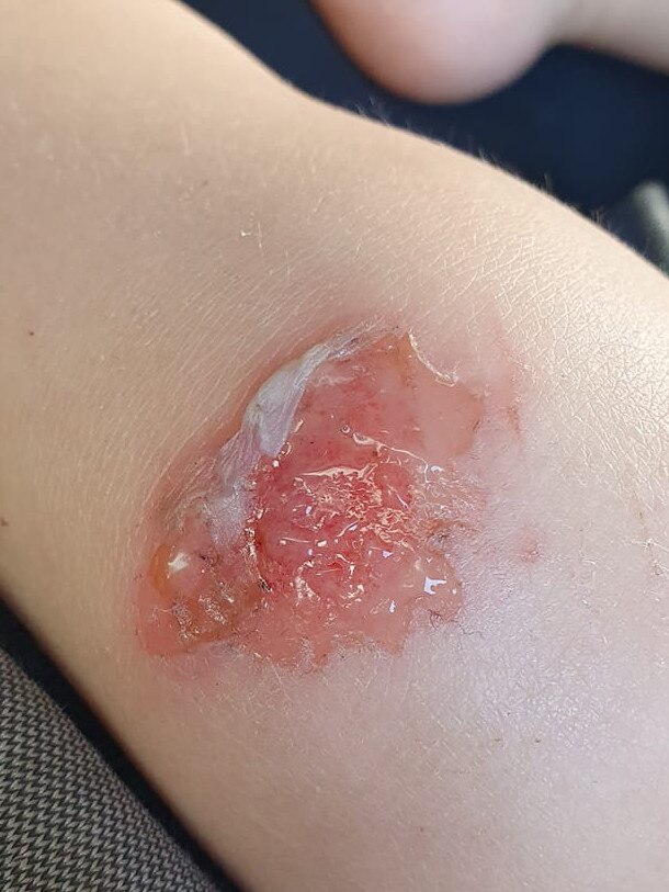 One child’s mosquito bite became infected. Photo: Facebook