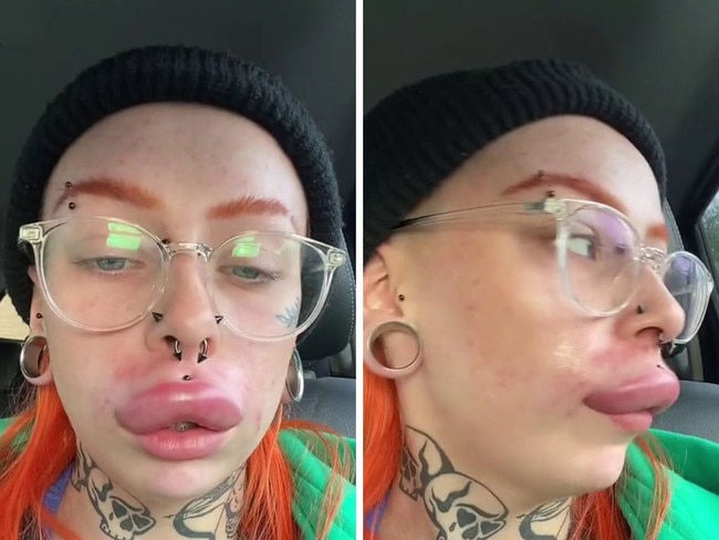 A woman has revealed that she got her dodgy ‘moustache’ lip filler dissolved and was stunned at how swollen her pout became. Picture: @hpxw