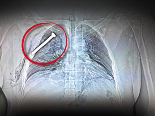 The x-ray image of a person injured during the Brussels terror attacks shows a big nail or screw in the chest of the patient treated at the Military Hospital in Neder-over-Heembeek in northern Brussels, 22 March 2016.