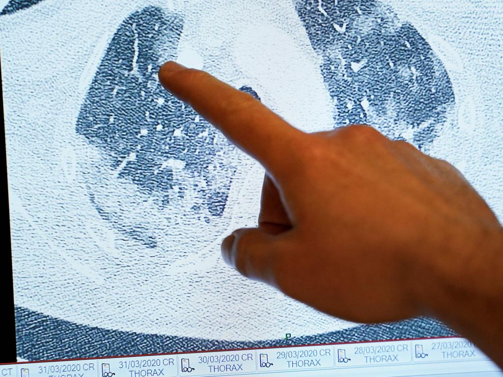 A doctor shows on screen the scan of the lungs of a patient infected by the COVID-19, at the "middle care" unit for COVID-19 infected patients at the Erasme Hospital in Brussels. Picture: Kenzo TRIBOUILLARD / AFP.