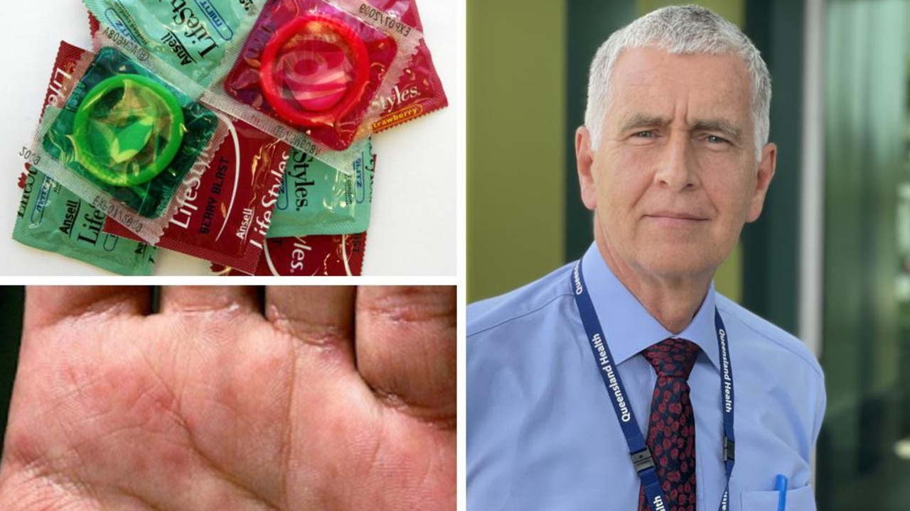 Mackay a syphilis hotspot as docs urge condoms testing on