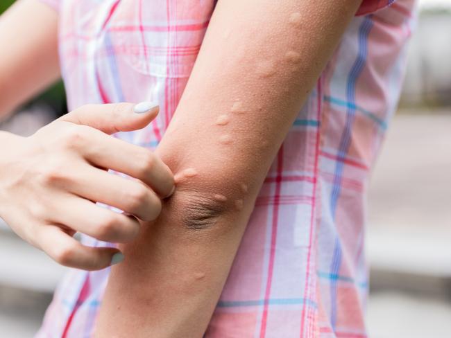 Arm of gilr is bitten by the mosquito and get bumps on her skin  in the summer