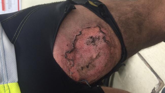 Gareth Clear suffered burns to his leg when his iPhone exploded after it suffered a minor impact as Gareth was mountain-biking. Gareth has needed skin graft surgery to aid in the healing process.