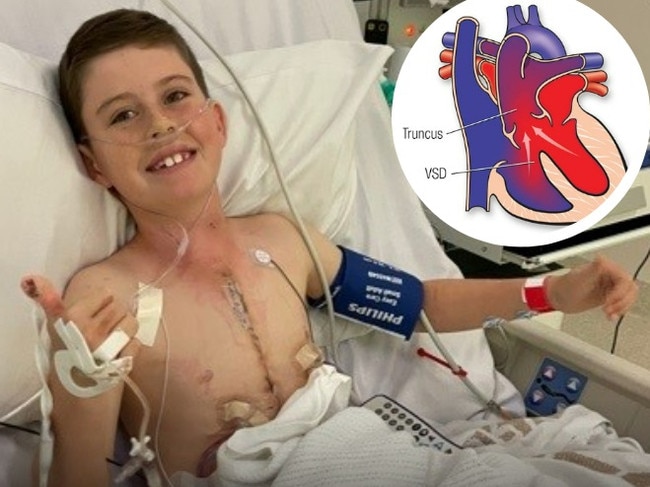 Townsville boy Jacob Painter, 10, has had three open-heart surgeries after being born with a rare heart defect. Picture: Sarah Painter.