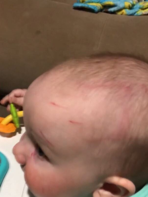 A Brisbane family claims their son Jack was left battered and bruised by an older child while at daycare. Picture: ABC 7.30/Angela Swindells