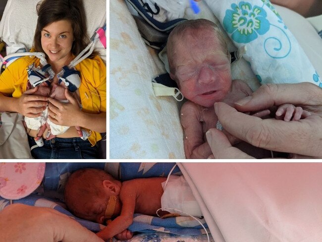 Babies’ life-and-death 72-hour wait after incredible in-utero surgery