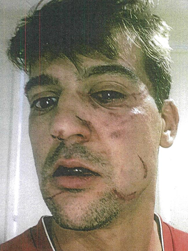 Brazilian national Vinicius Vargas after he was allegedly attacked. Picture: Supplied