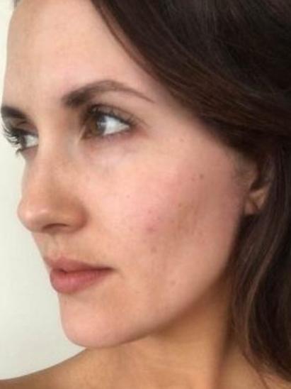 Makr-up free: Simone Lee Brennan from Married at First sight talks about her acne and scarring. From <a href="http://simoneleebrennan.com.au/blog/" target="_blank">simonleebrennan.com.au</a>