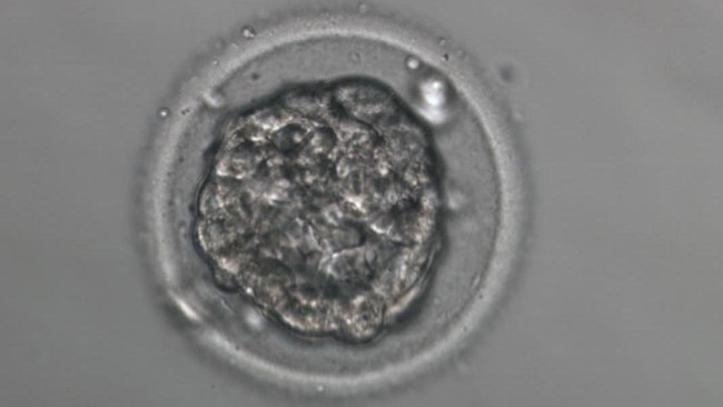 Emmett Nuske when he was an embryo. Picture: Supplied by family