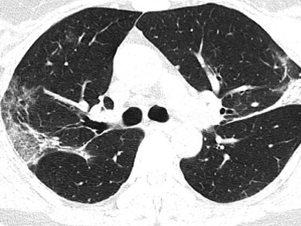 This CT scan shows the damage in the lungs of a 45-year-old woman from Sichuan Province in China who tested positive for COVID-19. Picture: RSNA