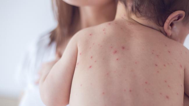 Children need a second dose of chickenpox vaccine. Picture: Getty Images