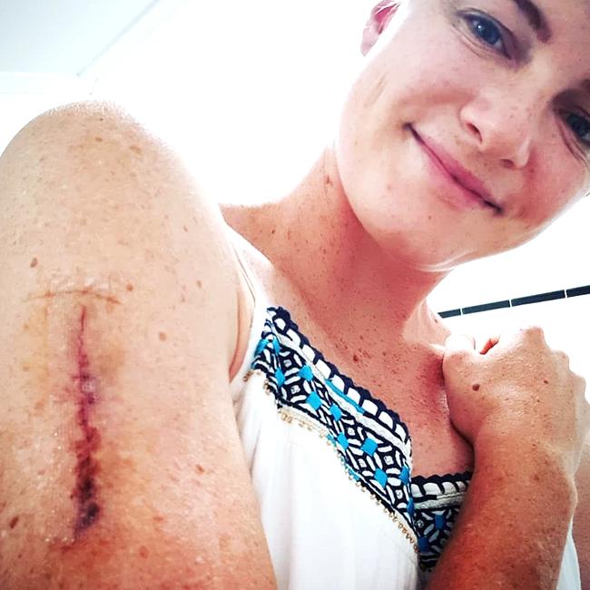 Campbell had a stage one melanoma cut out of her arm in November, 2018. Photo: Instagram.