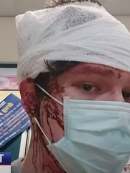 Good Samaritan Ruben Barry has a “permanent dent” in the side of his head after Mitchell Haskell struck him with a hammer in October 2021. Picture: 7NEWS