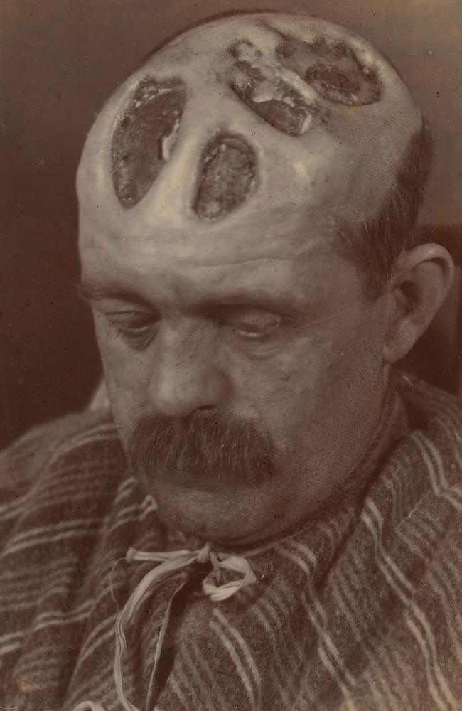 A man aged 39 years, who had contracted syphilis 12 years previously, with tertiary syphilitic ulceration of the scalp. Picture: Wellcome Library