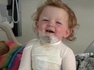  Toddler undergoes skin grafts after boiling tea leaves severe burns 