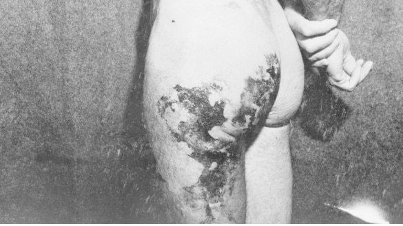 Blisters on the body of an Australian volunteer sustained during chemical warfare (CW) trails. Credit: Australian War Memorial