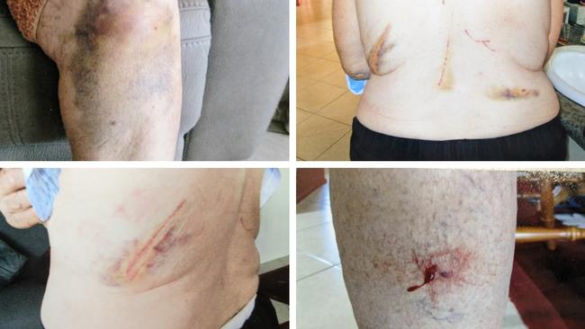 The injuries after the wallaby attacks.