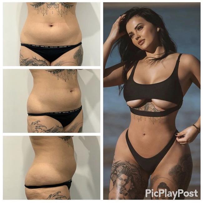 Renee Gracie before and after a Brazilian Butt Lift. Picture: Dr Mitchell Kim from Cosmos Clinic