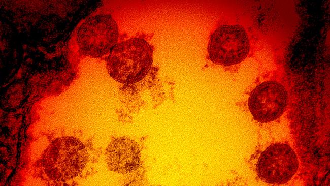 A transmission electron micrograph of SARS-CoV-2 virus particles, isolated from a patient. Picture: AFP