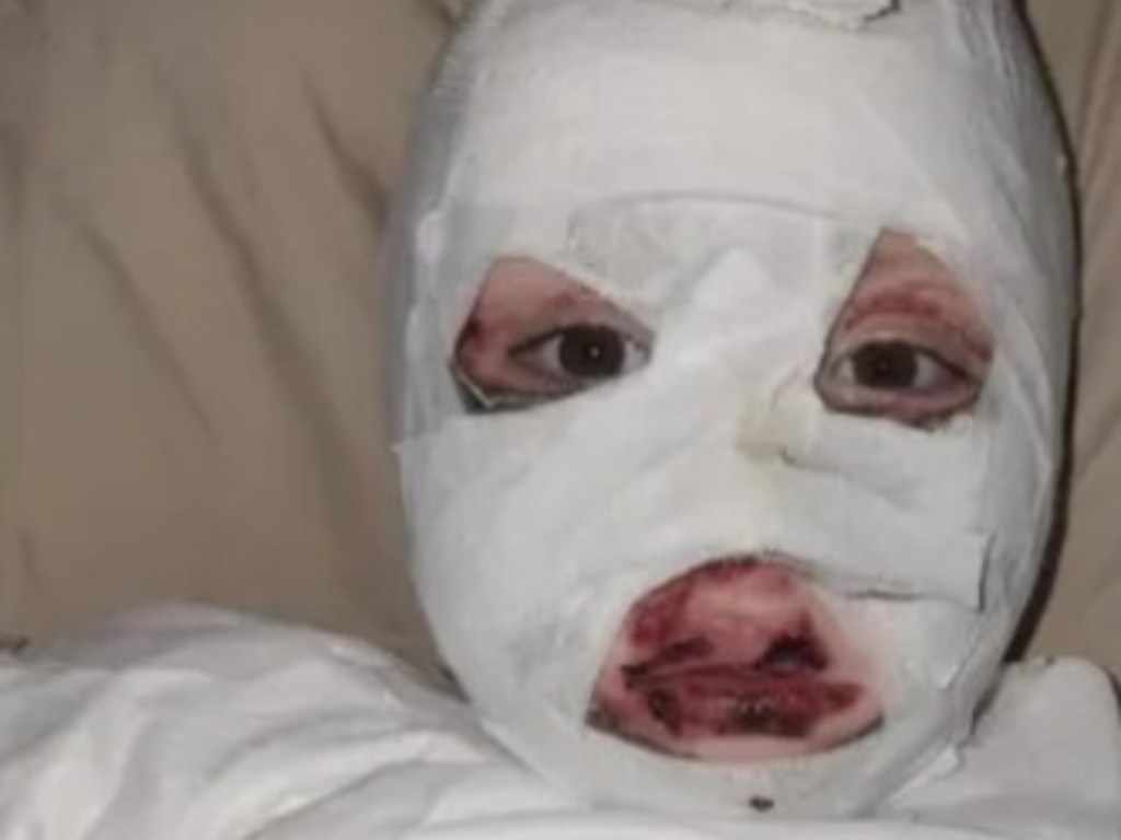 Daniella’s mother says the eight-year-old’s skin ‘melted off’. Picture: Supplied