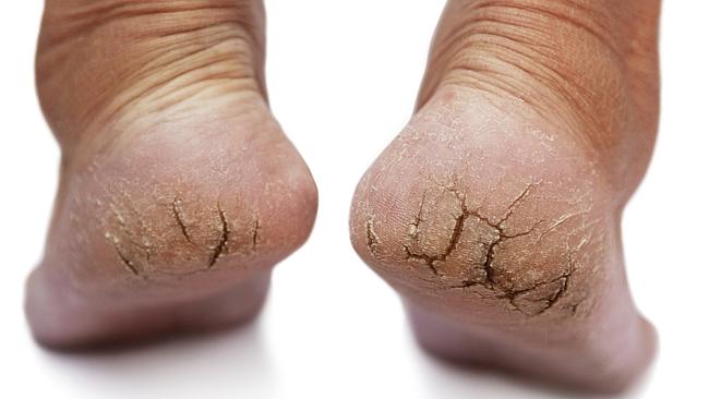 Gross feet need to be hidden away under socks and shoes. Picture: Thinkstock