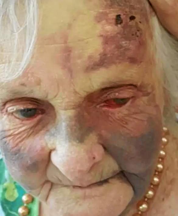 THE CIRCUMSTANCES surrounding an elderly woman's facial injuries sustained during her time at a Coffs Harbour nursing home is under investigation by federal authorities. Picture: Contributed