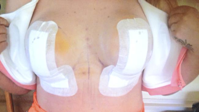 Woman's Breast Implants Fall Out After Botched Surgery