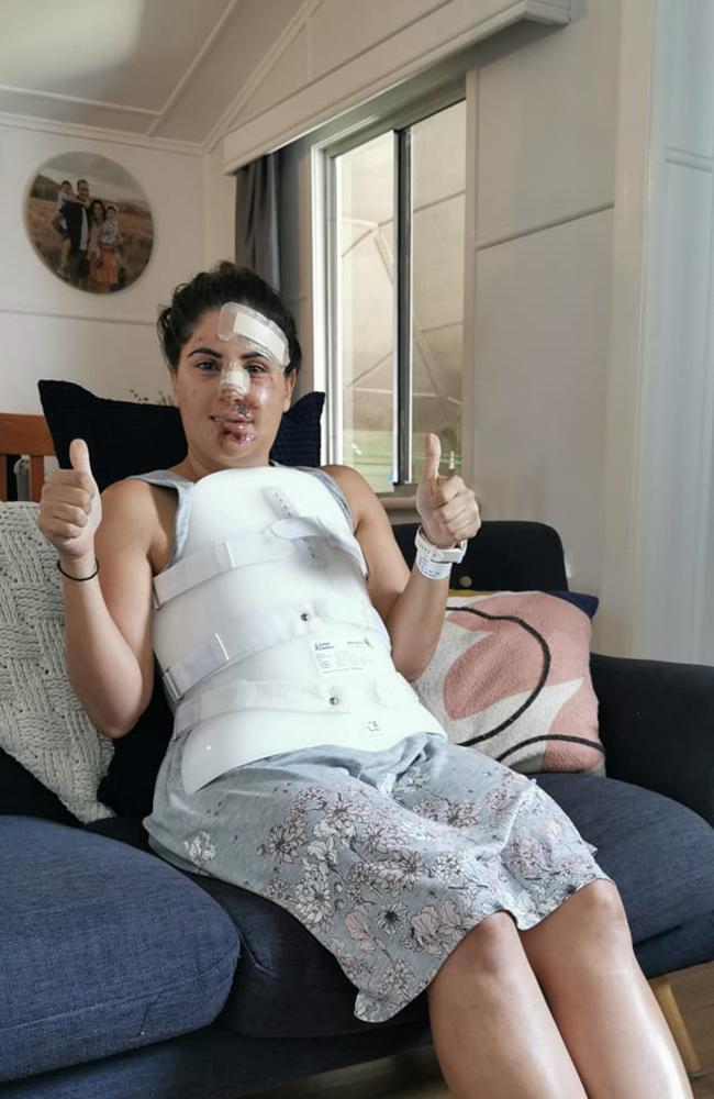 Deanne Woods after he bike accident that left her with facial injuries and a broken spine, 2021.