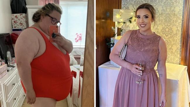 A woman who ate 10 chocolate bars a day shed 120 kilograms thanks to surgery and would “do it again” – despite losing her gallbladder. Picture: SWNS