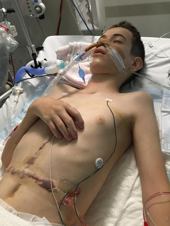 Cooper Taber had his first liver transplant at 8 months of age and his second at age 14.