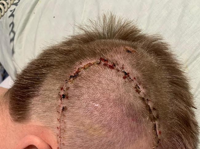 Harry Frolling bears the scars of surgery to repair his fractured skull and alleviate bleeding on the brain after he was attacked in Wollongong in 2023. Picture: Shane Froling/Twitter