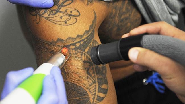 New Tattoo Removal Clinic