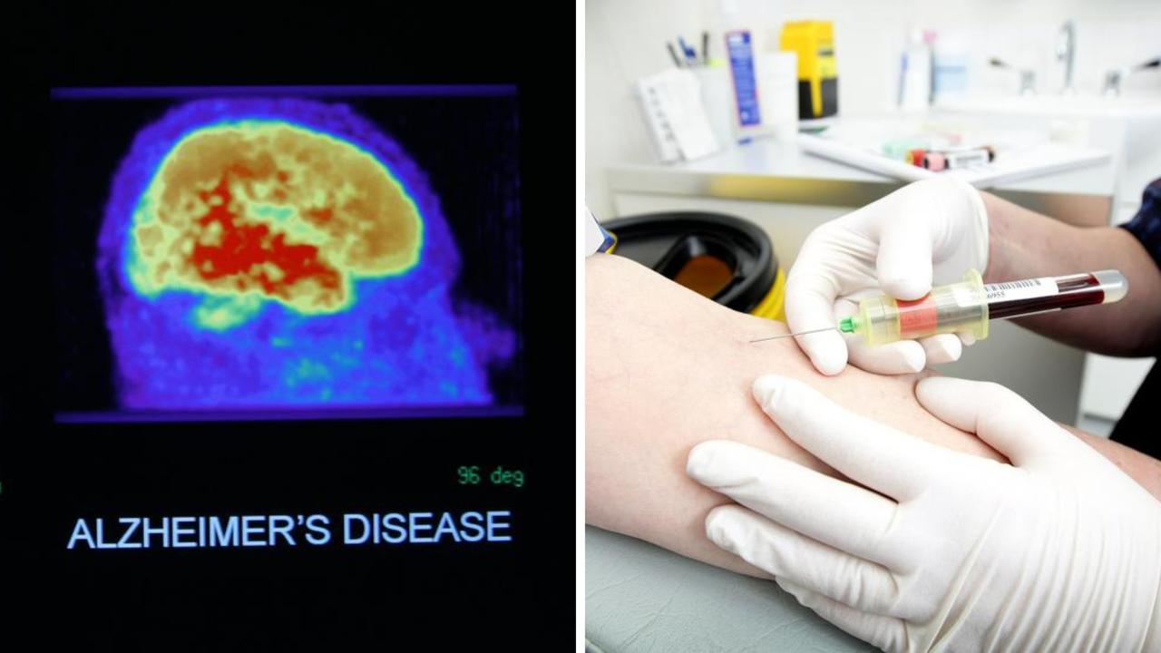 ‘Impossible’: Blood test accurately diagnosed Alzheimer’s in 90 per cent of cases