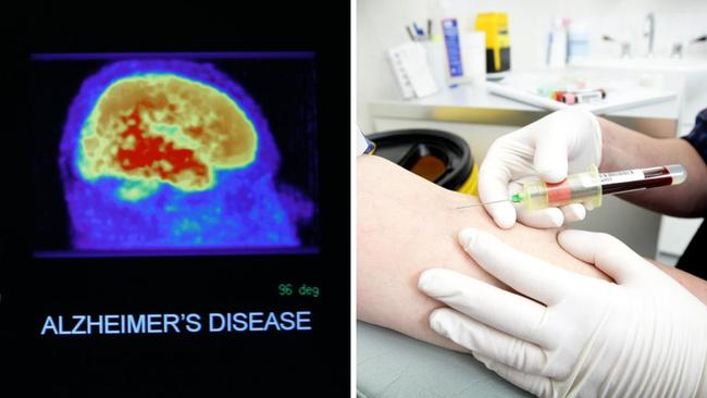 Groundbreaking blood test technology could be the key to diagnosing Alzheimer’s, new research has found.