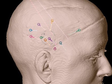 12 intracranial stereo-electrodes inserted into the right side of the brain to record seizures.