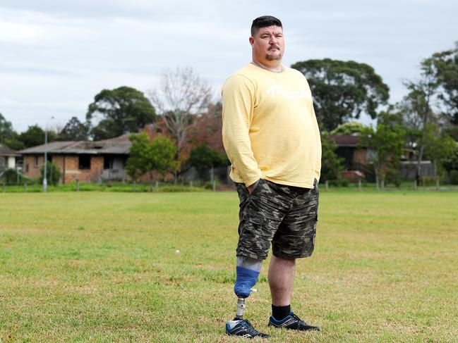 David Openshaw, who has BIID, plunged his leg in dry ice to get it amputated. Picture: Tim Hunter