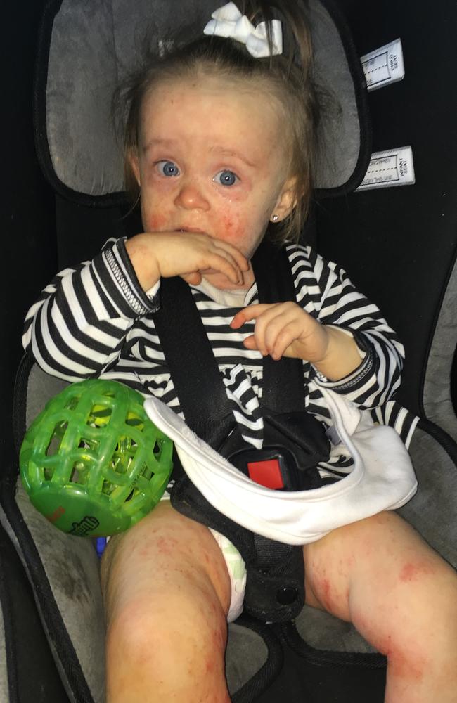 Charlotte Little’s eczema escalated from when she turned one.