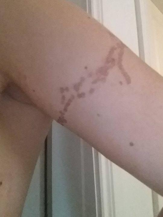 Ms Rukin’s faded tattoo after a couple of laser removal sessions. Picture: Supplied